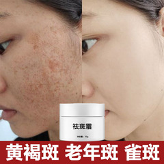 美白・そばかす防止クリーム、強力そばかす・シミ・肝斑・日焼け・ニキビ跡・メラニン除去・エステサロン・フライドスポットクリーム