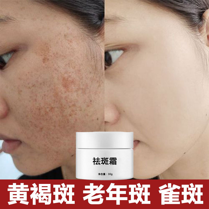 美白・そばかす防止クリーム、強力そばかす・シミ・肝斑・日焼け・ニキビ跡・メラニン除去・エステサロン・フライドスポットクリーム|undefined