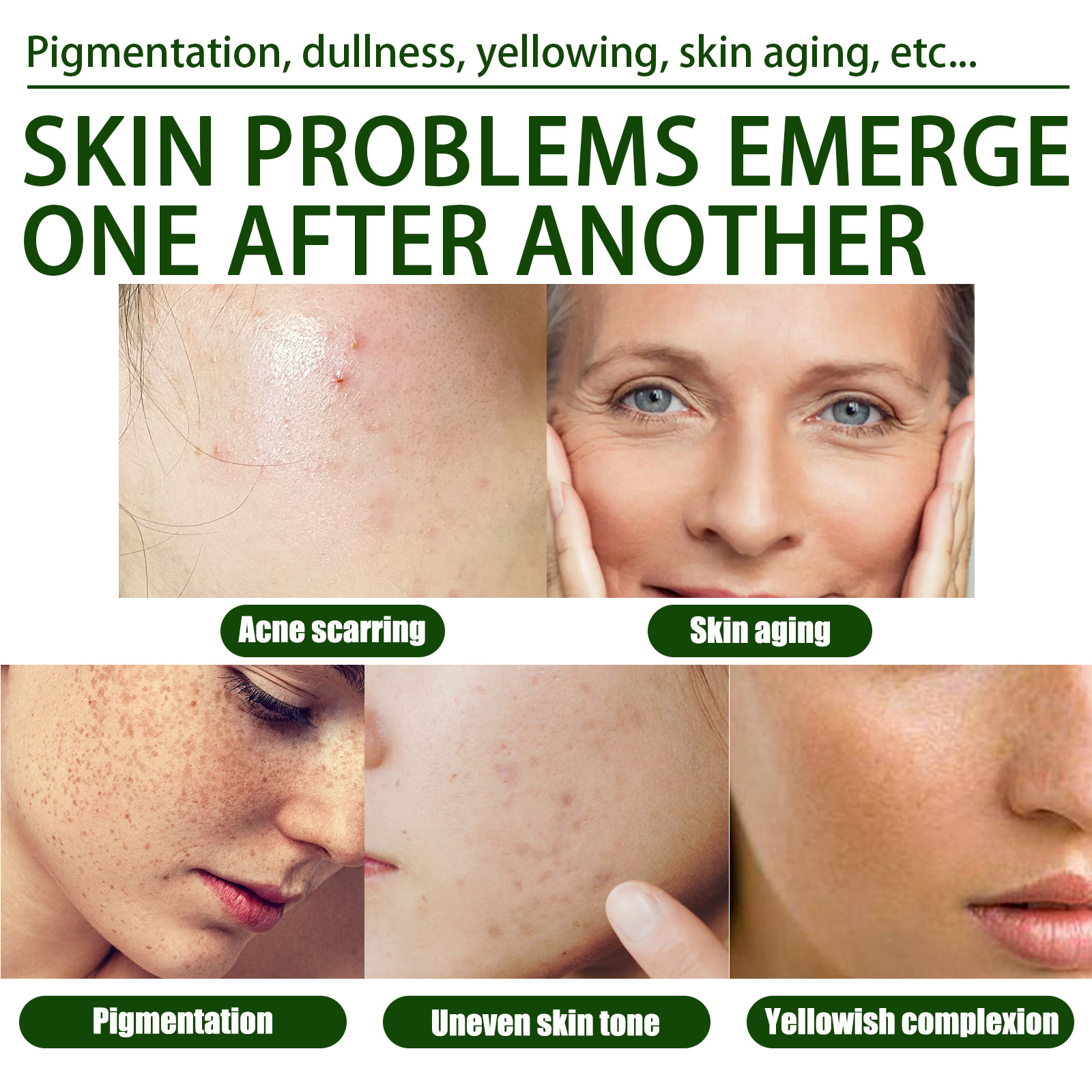 Esence s olivovým olejem West&Month pro odstranění akné se zavřenými ústy, zesvětlení skvrn po akné a opravu tmavé pleti_voghion.com