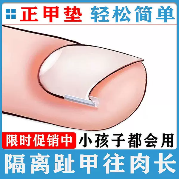 Ingrown Toenail Corrector Pads, Nail Pads, Isolation Pads for Toenails Growing into the Flesh, Correction Patches for Toenail Inflammation