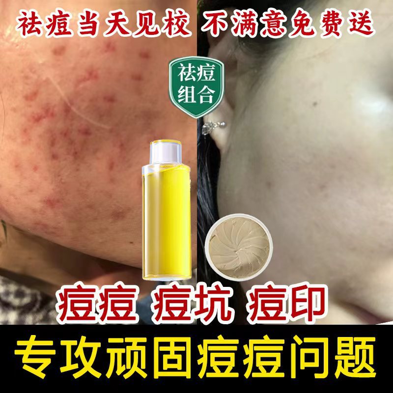 中薬祛痘膏淡化痘坑痘印温和滋润控油去粉刺闭口祛痘精华两件套装