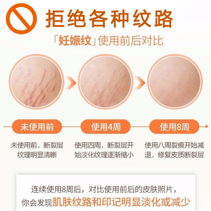 妊娠の紋様の修復クリームは薄い紋様を引き締めて太っている紋様を取り除きます。|undefined