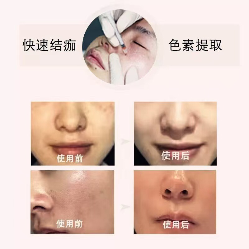 美容院专用提取液雀斑老年斑真皮斑点斑水黑色素分解面部精华美白|undefined