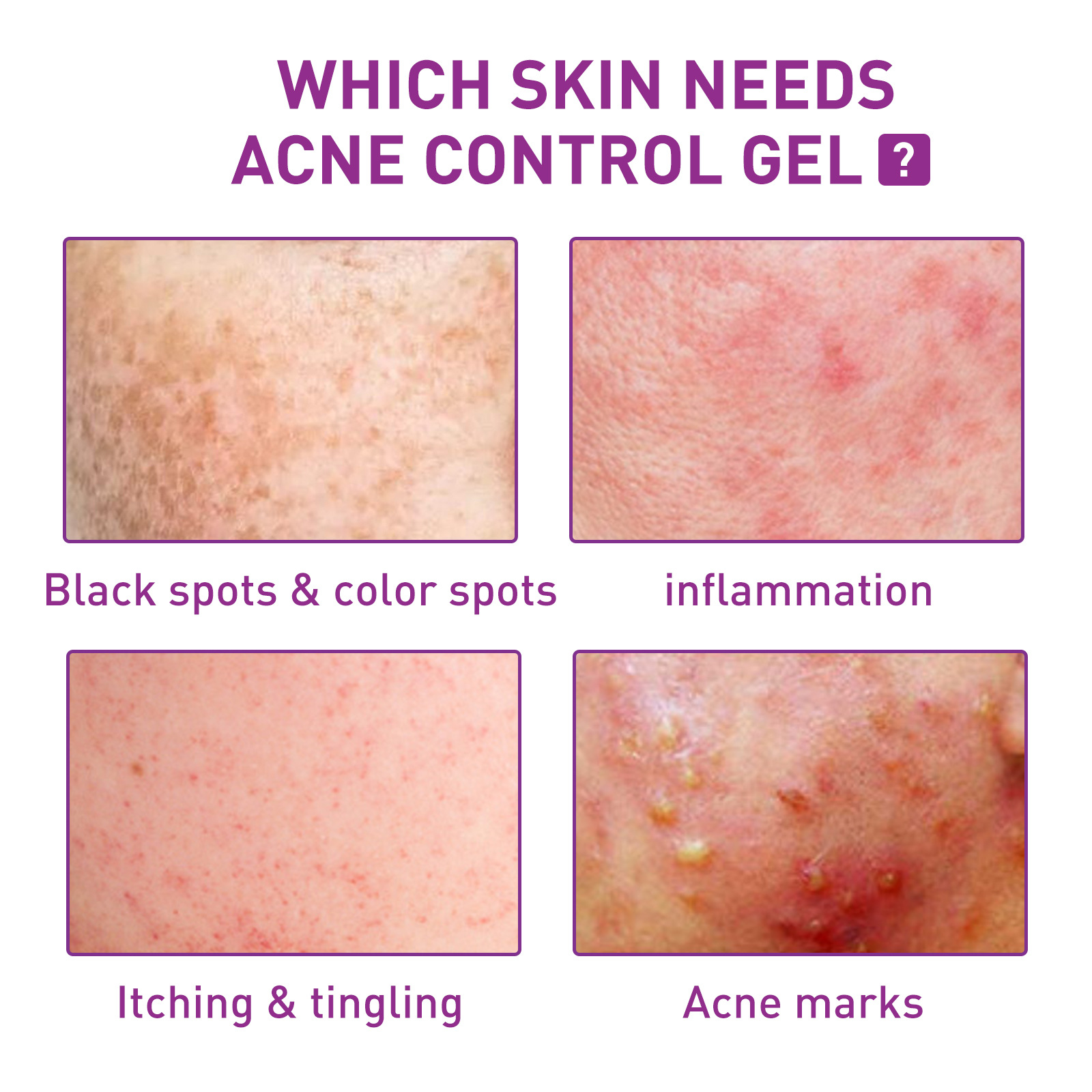 EELHOE Spot Lightening Whitening Cream mindert Akneflecken, repariert dunkle Flecken, spendet Feuchtigkeit, festigt und verbessert die Haut_voghion.com