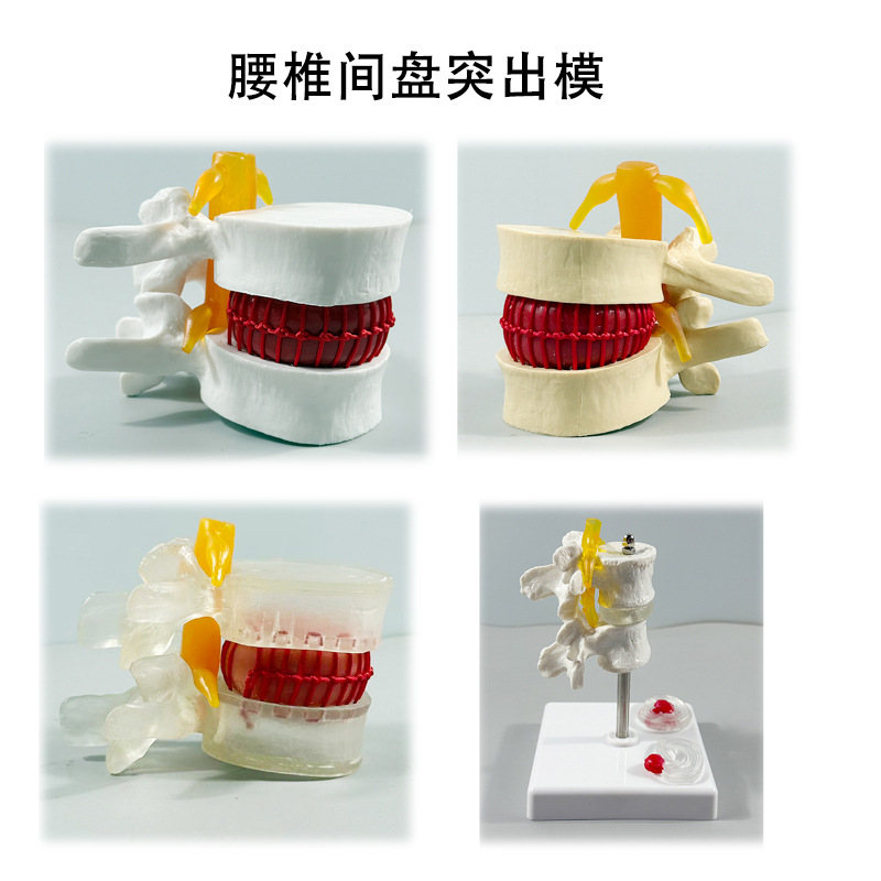 Production of Lumbar Spine Models, Teaching Aids for the Demonstration of Spinal Bone Protrusions and Pathological Bone Conditions, and Demonstration of Lumbar Disc Compression in the Human Body