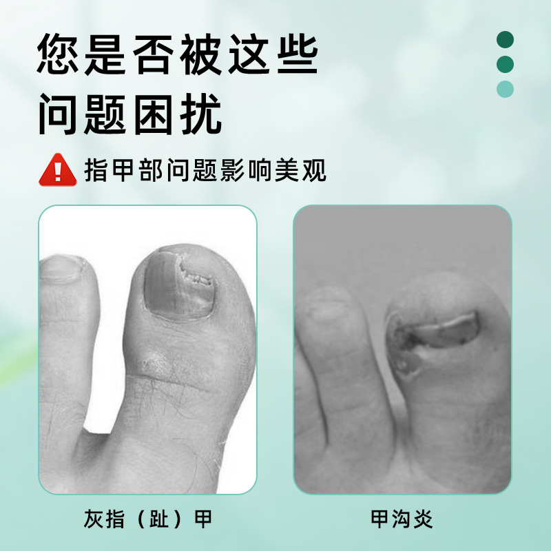 爪真菌症用の Renzhu 特別ボックス、爪真菌症と爪周囲炎のツーインワン ヘルスケア ソリューション キット、爪を厚くして壊れた爪を除去します。|undefined