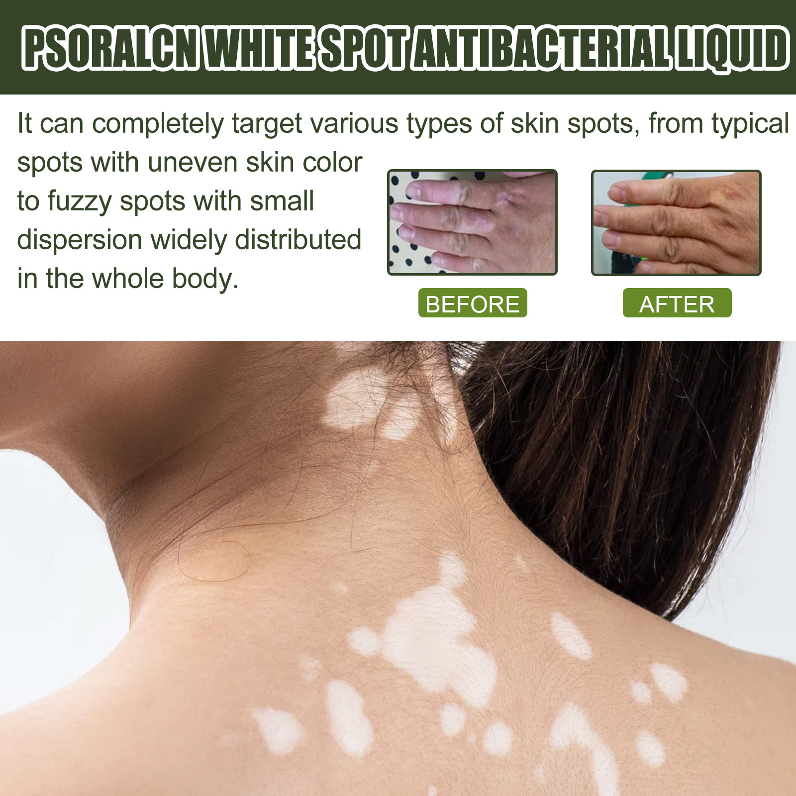 EELHOE Entferner Haut Leukoplakie Schweißfleckennetz Außenpflege Psoralen Essenz_voghion.com