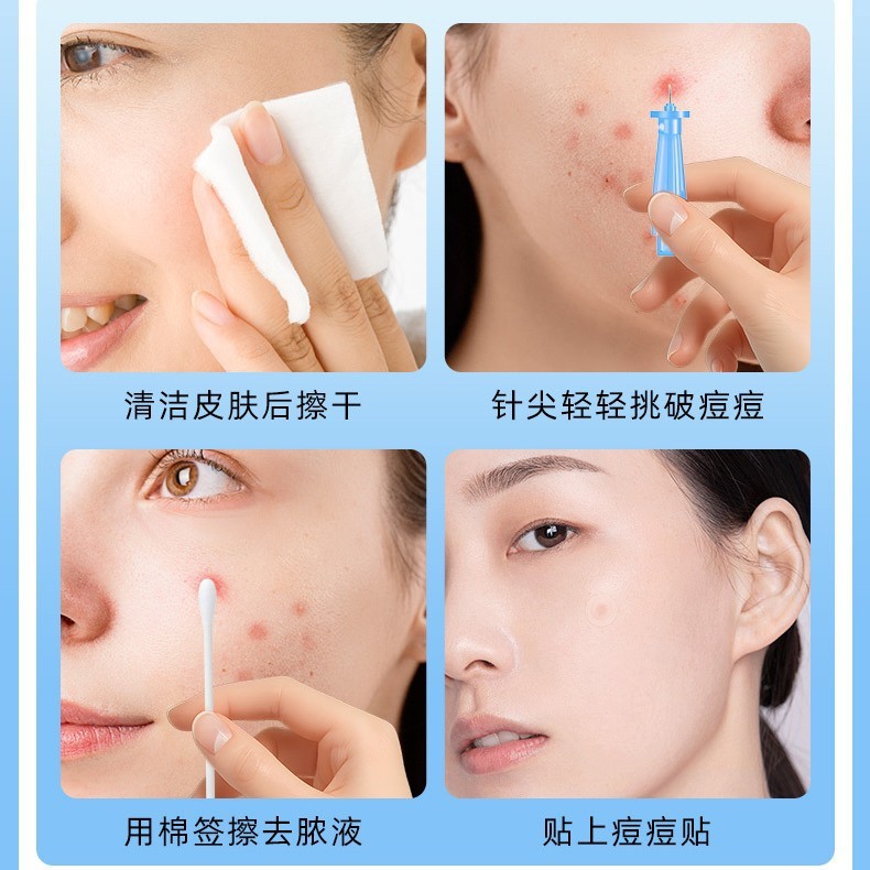 一次性粉刺针超尖细排痘祛痘针脸部挑痘清痘闭口暗疮针院专用|undefined