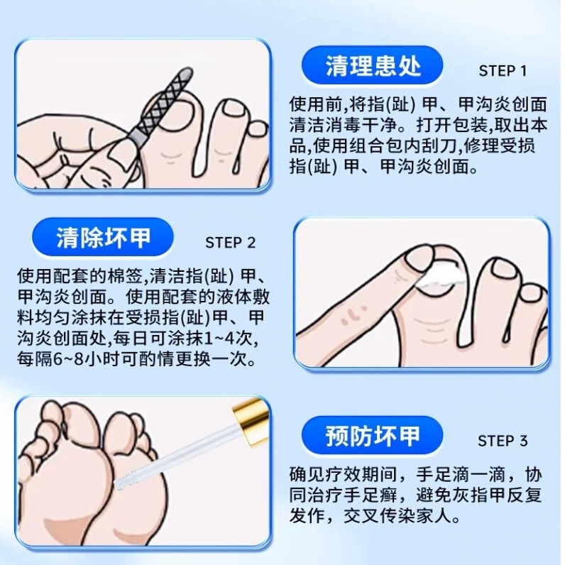 北京同仁堂灰指甲 甲沟炎 甲癣 医用指甲创面护理盒 液体敷料|undefined