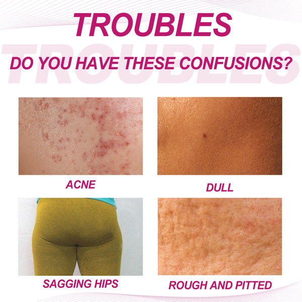 EELHOE Soft medical acne cream full body