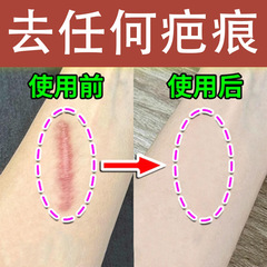 傷跡除去クリーム、傷跡除去クリーム、跡のない古い傷跡の修復、傷跡除去クリーム、過形成傷跡の修復、火傷傷跡、帝王切開傷跡