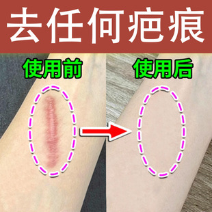 Remove Scar Cream Remove Scar Cream Repair No Mark Old Scar Scar Cream Remove and Repair Hyperplastic Scar Hot Scar Caesarean Section Scar