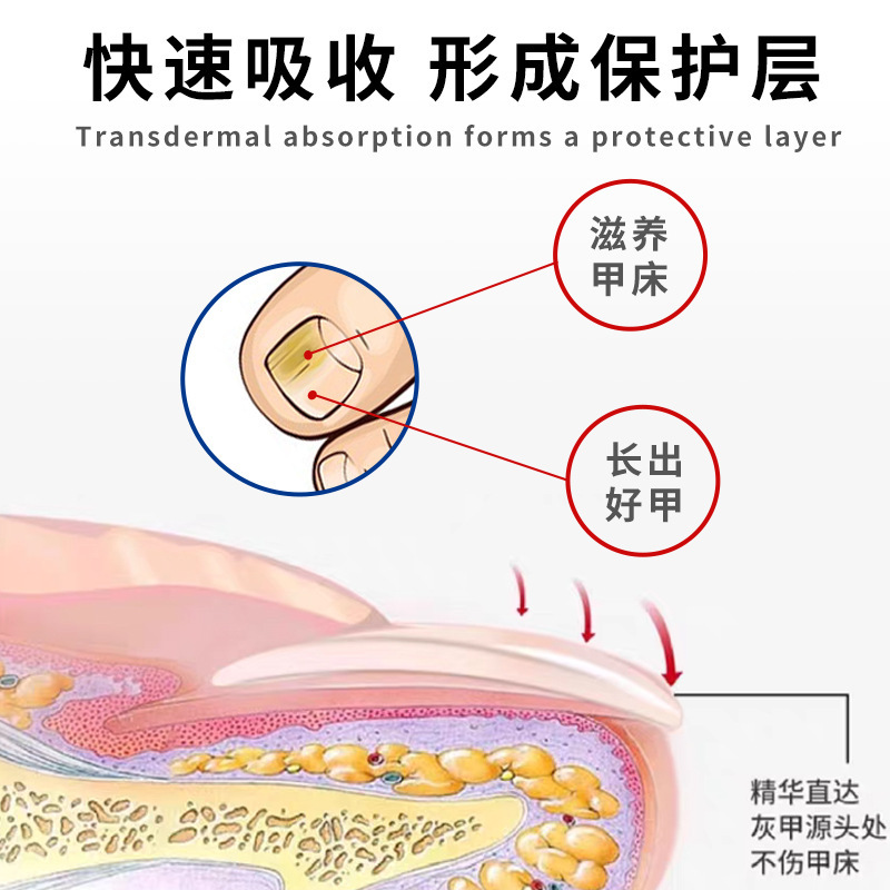 淮南堂灰甲康爪真菌症液体除去クリーム爪真菌症浄化爪軟化フットケアクリーム|undefined