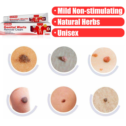 South Moon Pinghou Youke Wart Cream, Wart Cream, Hands, Feet, Face, Armpits, Neck, Filamentary Suppression of Warts