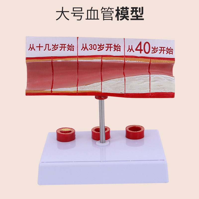 Modelo de la arteria coronaria Modelo de la arteria cardiovascular modelo de endurecimiento