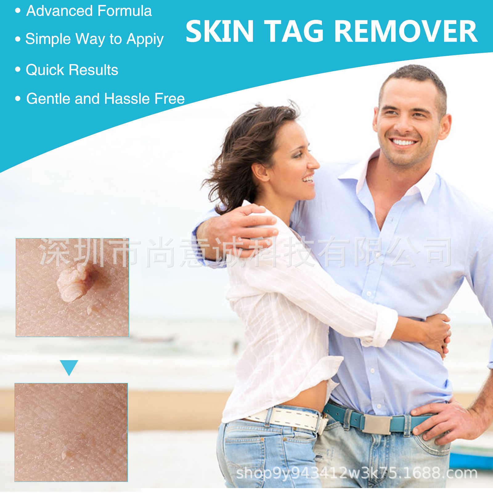 Comercio exterior transfronterizo modelo privado Etiqueta De piel removedor eliminación de verrugas conjunto de pluma de eliminación de piel pluma de eliminación de mole de carne removedor de verrugas