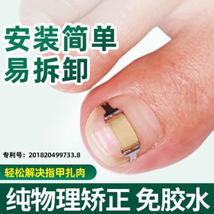 Nail Groove Ingrown Toenail Corrector, Nail Patch, Nail Buckle, Nail Corrector, Ingrown Toenail Correction Patch, Nail Correction