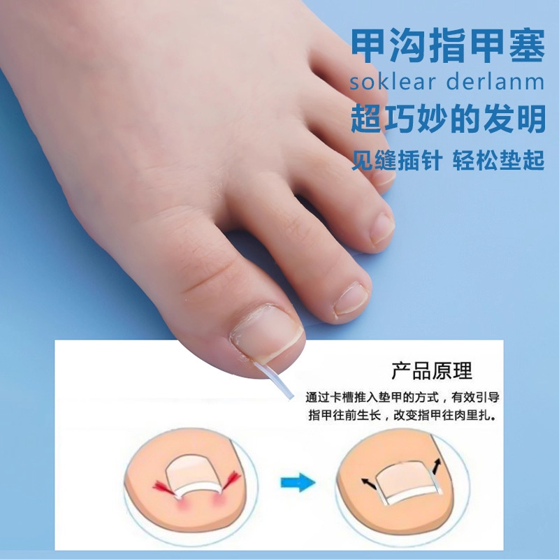 甲沟指甲矫正器嵌甲炎通用填充垫片脚趾甲防往肉里长正甲纠正工具|undefined