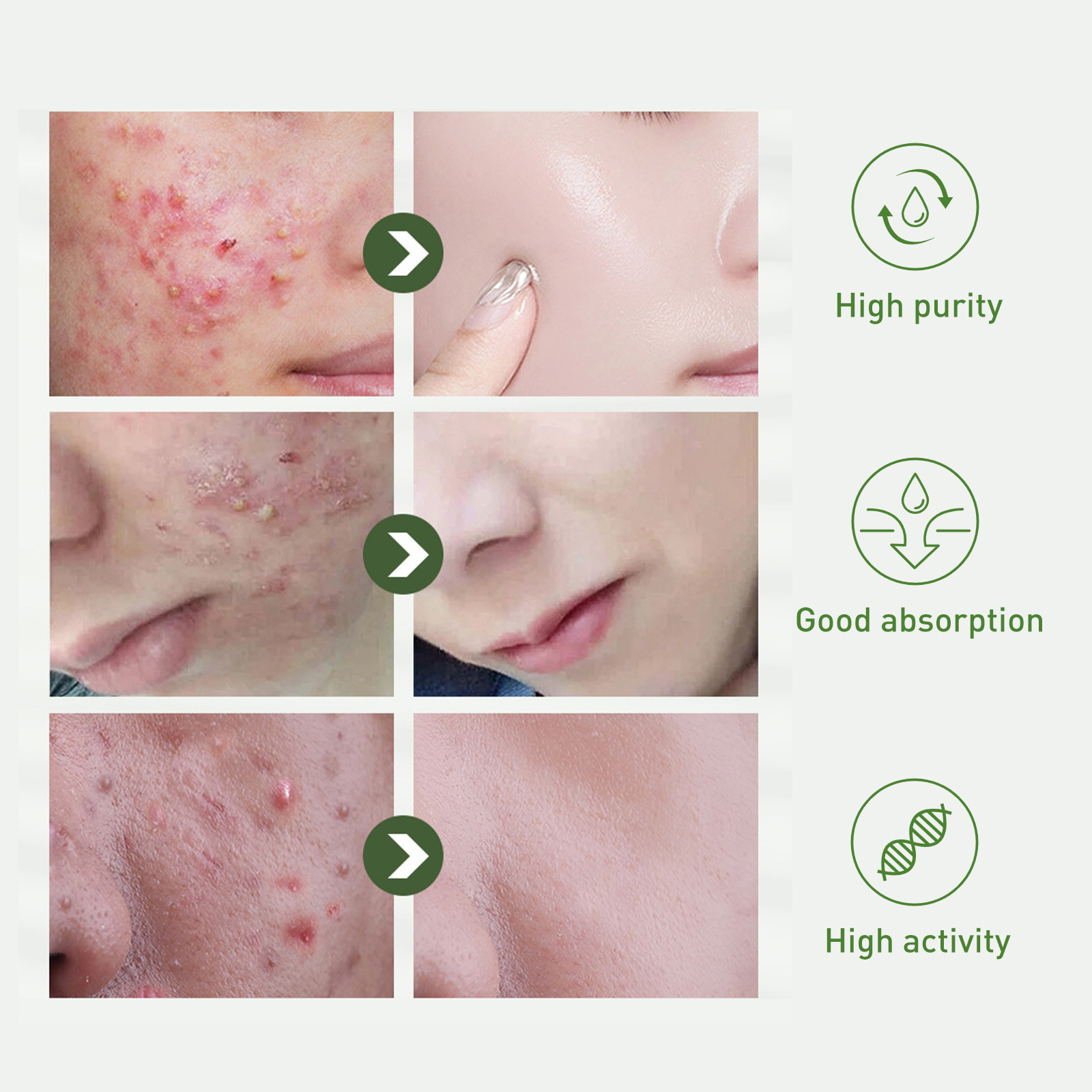 Jayswing Tea Tree Oil Lightens Marks, Moisturizes Repairs Facial Sensitivity, Reddening and Acne Removing essence_voghion.com