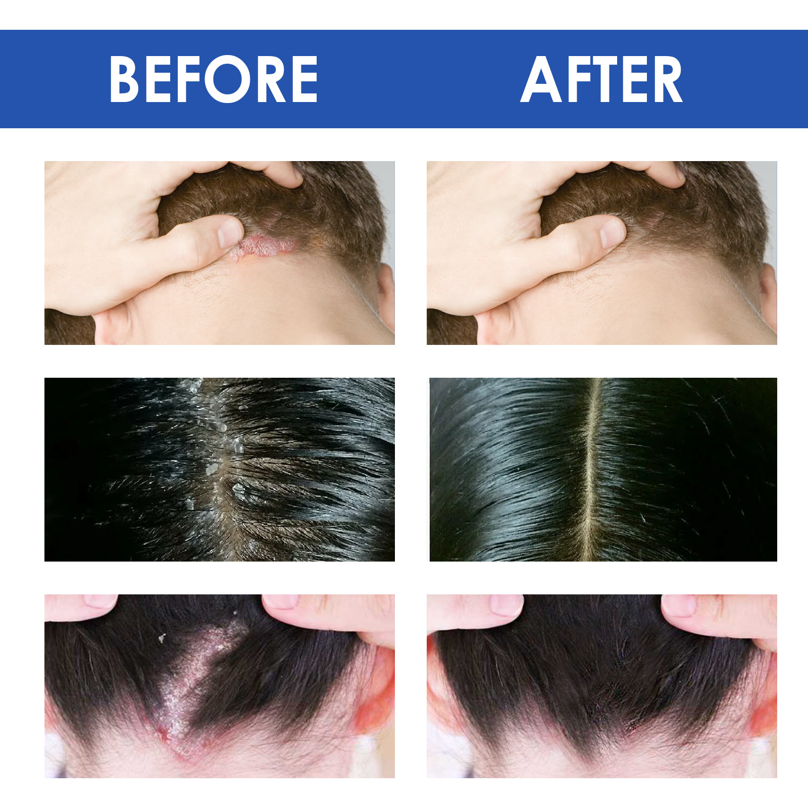 South moon seborrheic skin cream head acne itching scalp ringworm skin problem repair skin cream_voghion.com