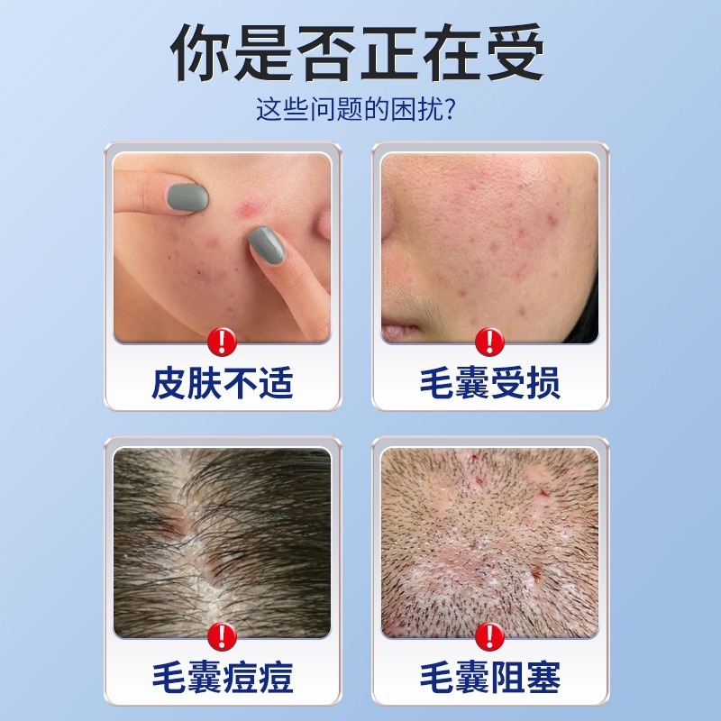 Qiu Yana Xu 毛包クリームは、毛包の痛み、かゆみ、ニキビ、頭皮のニキビ、不快感、ニキビの外用ケアクリームを和らげます。|undefined