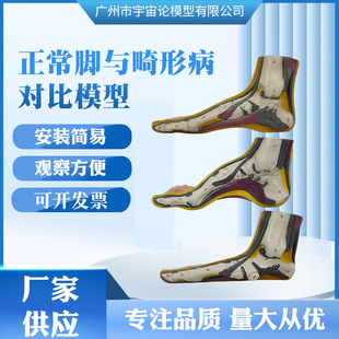 Manufacturers Supply Human Health Foot and Human Deformation Pathological Foot Comparison Model Internal Organs Pathological Demonstration