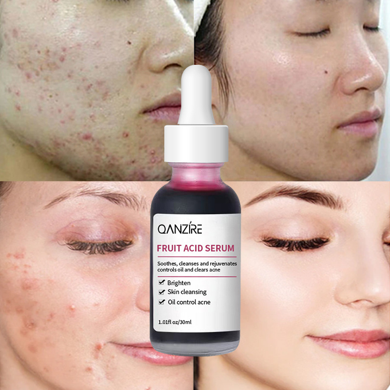 Uebst Säure Essenz, fein Poren, propper Haut, hellen Toun, erweicht Cutin, Hautfleeg Essenz_voghion.com