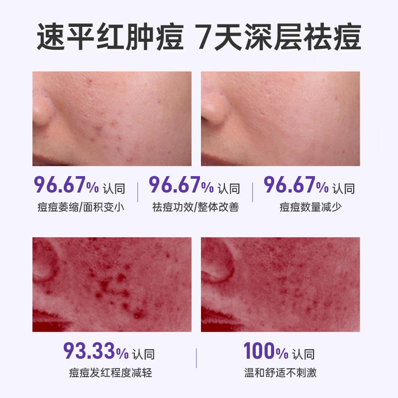 Professional Beauty Salon Line Exclusive Products Not Available Online: Anti-Acne and Acne Mark Fading Essence, Skin Care Products, Moisturizing Cosmetics, Franchise 2