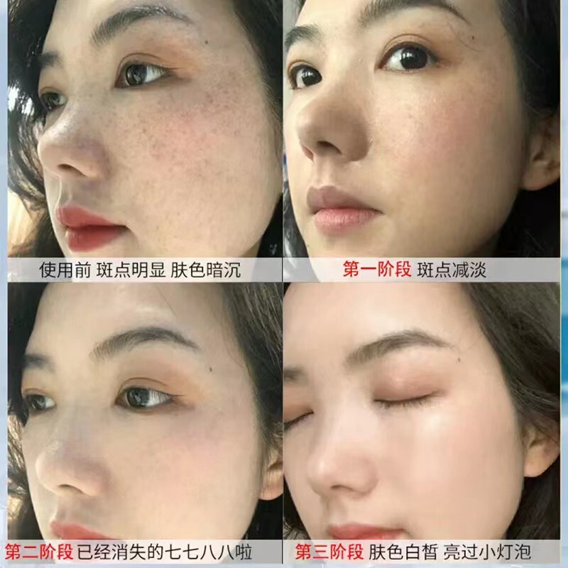 高濃度トロンビンクリーム、そばかす除去、美白、肝斑除去、シミ、そばかす、日焼け、メラニンコントロールクリーム|undefined