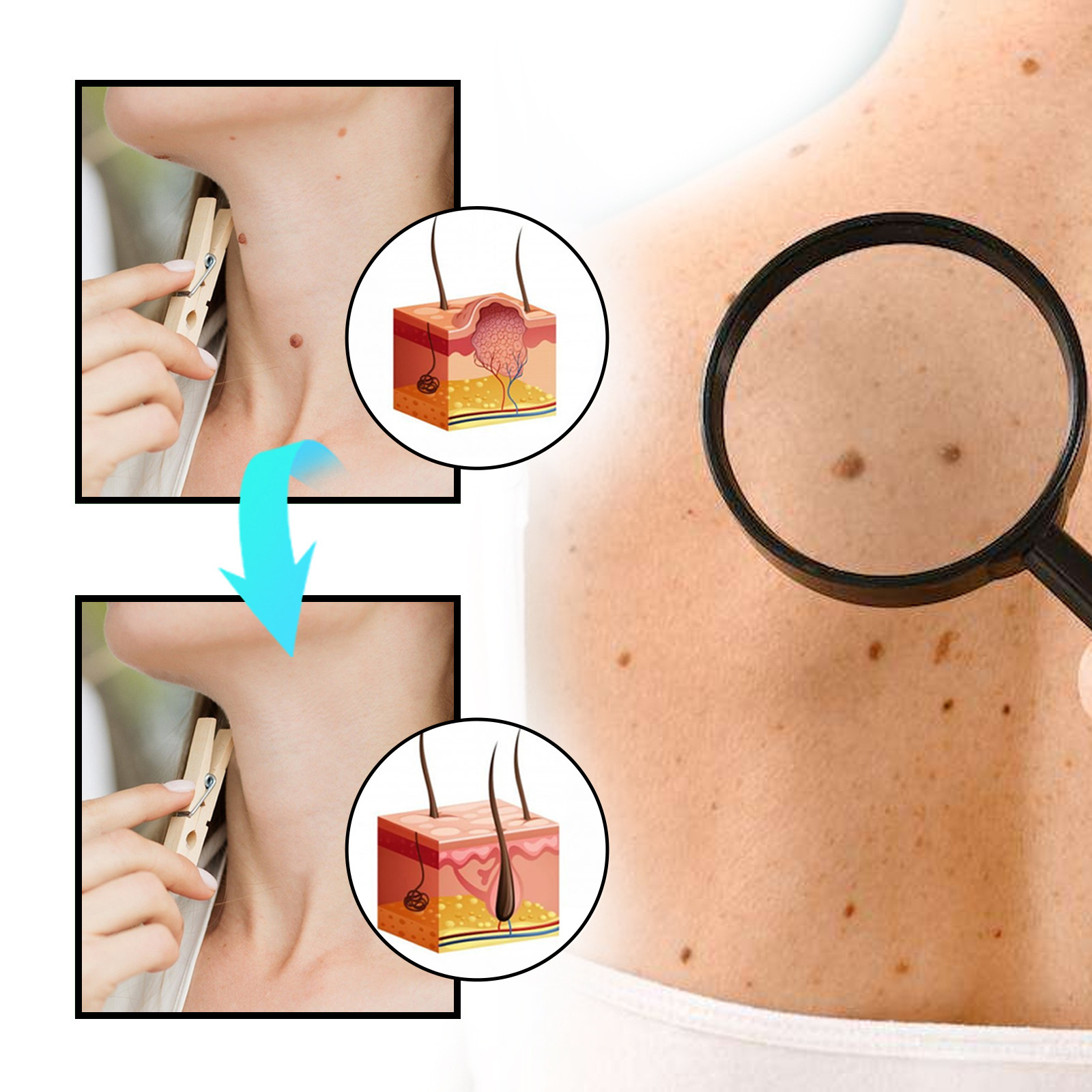 Ximonth蜂毒克いぼ看護スプレーは体をきれいにします。