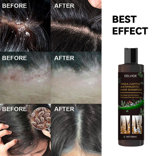 EELHOE Anti-Itch Shampoo for Dandruff Relief, Itch Relief Shampoo, Anti-Hair Fall Shampoo, Refreshing Oil Control Hair Protection Shampoo