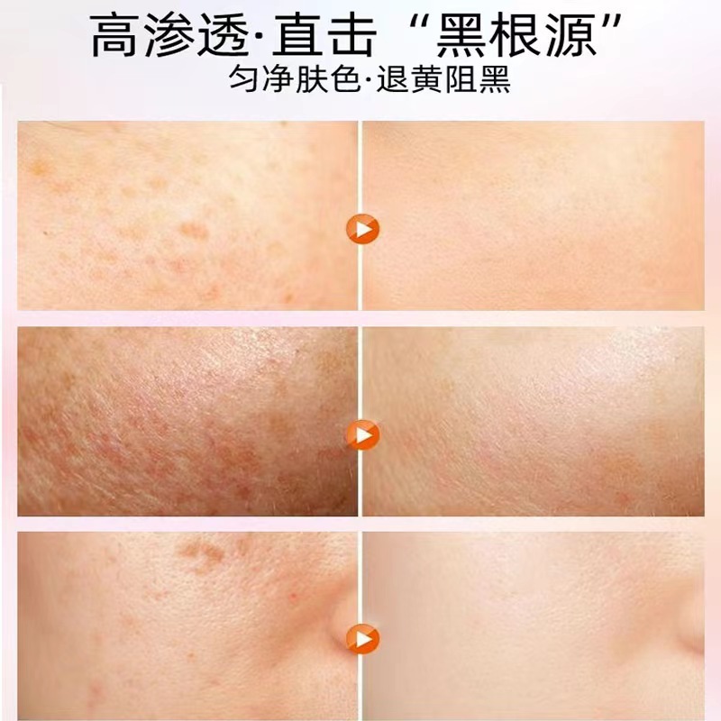 甘草エッセンス ナイアシンアミド 美白・メラニン減少・そばかす・肝斑除去 高濃度原液|undefined