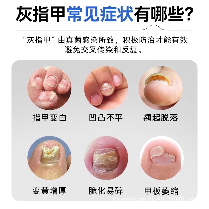 Máquina de fototerapia de uñas grises, lámpara de hongos láser, tratamiento de limpieza, esterilización ultravioleta azul, aparato de enfermería de uñas grises JJ