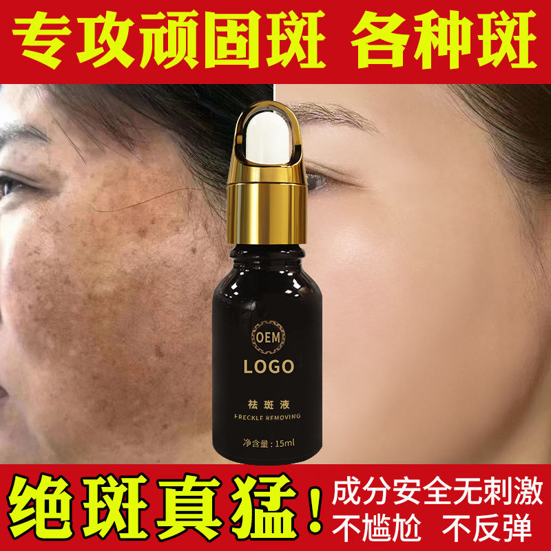 No Embarrassment Period, Effective Freckle Removal Liquid, Anti-Freckle and Chloasma Color Removal Liquid, Color Decomposition and Metabolism Liquid, Whitening and Freckle Removal Essence Manufacturer