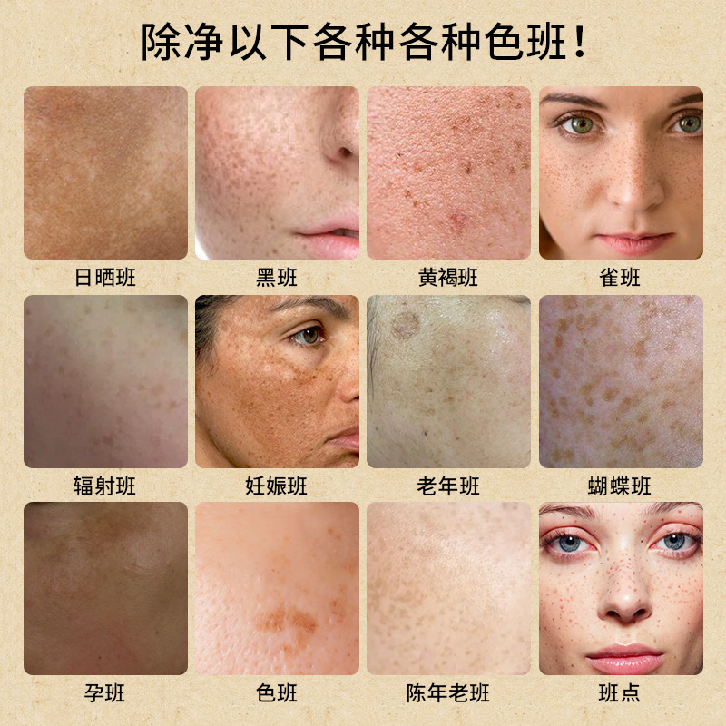 無期美白シミ取りクリーム淡化黄褐斑日焼け斑ソバカス老人斑淡化シミ改善くすみ|undefined