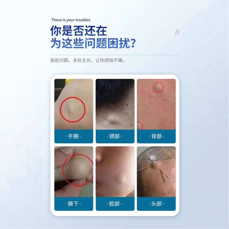 香港大薬局脂肪康正規品、皮下の硬い塊を和らげる全身用クリーム、単発性・多発性に塗布可能、吉医星|undefined