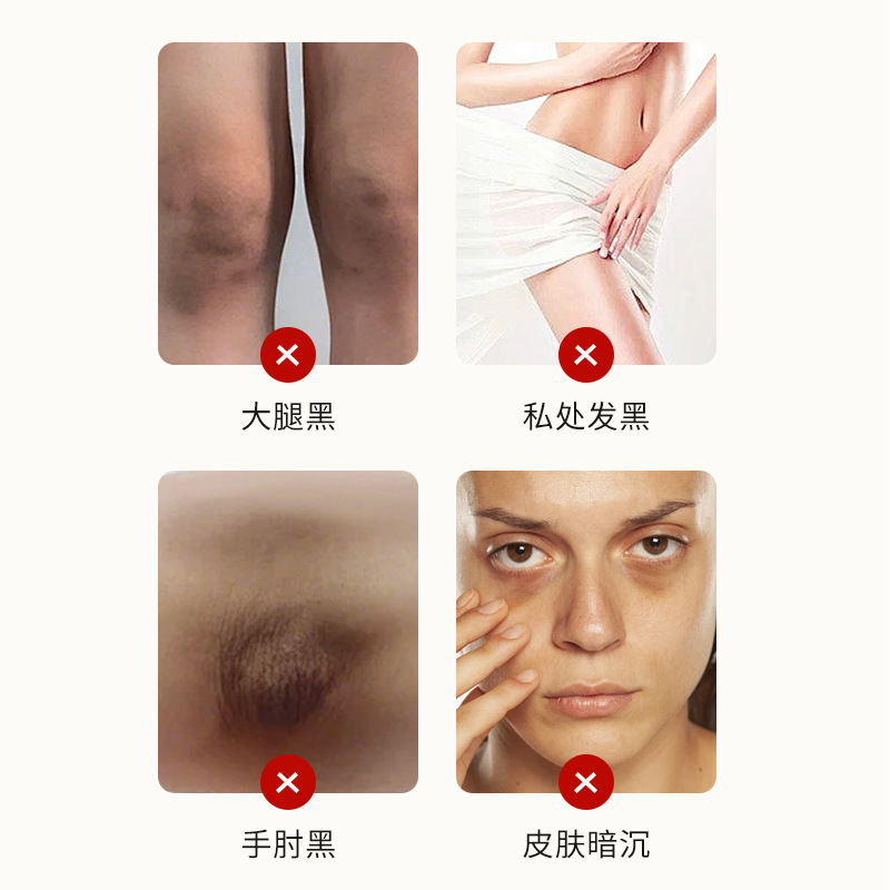 ピンクの黒のエッセンスクリームは関節の黒ずみを緩和します。|undefined