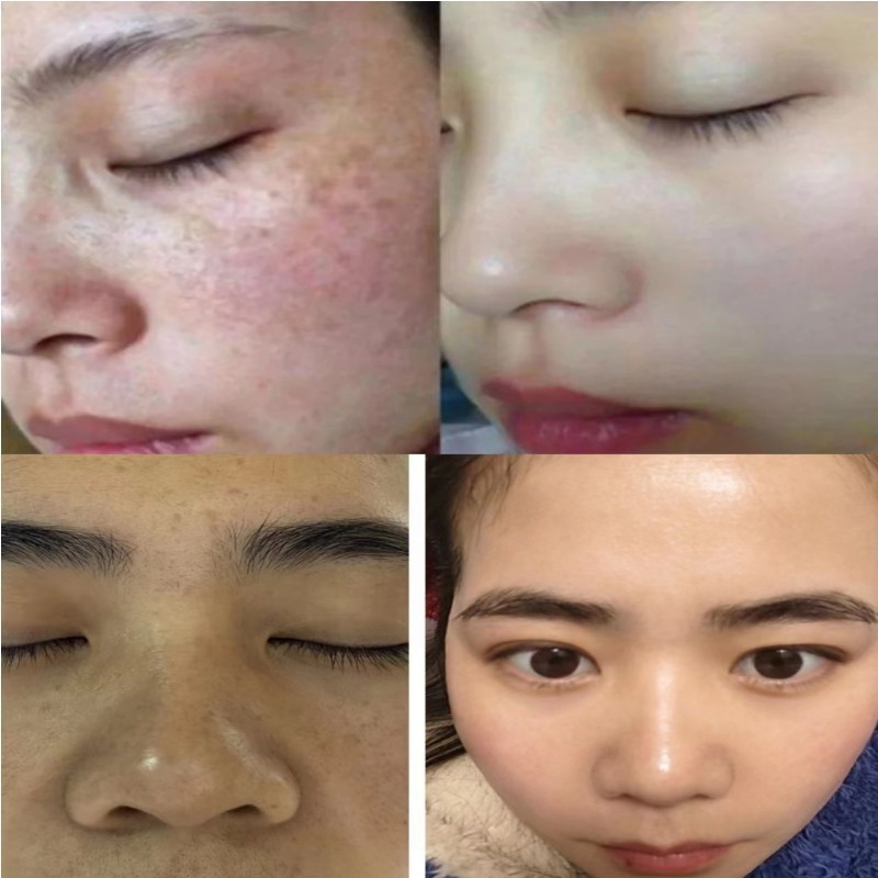 祛斑霜炸斑霜美白强效徒手祛斑黄褐斑黑色素祛斑液套装美容院专供|undefined