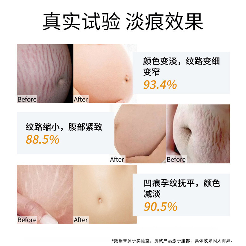 妊娠の紋様の修復クリームは薄い紋様を引き締めて太っている紋様を取り除きます。|undefined