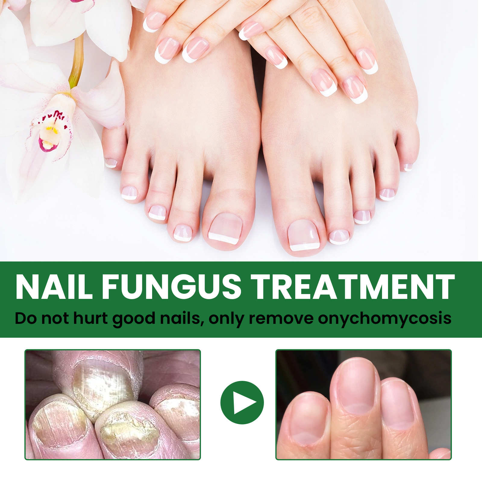 EELHOE Foot Care Grey Removal Damage Dicke und helle Nagelreparaturflüssigkeit_voghion.com