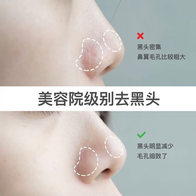 頭導出液は黒頭美容院に行って、果酸収縮毛穴のにきびの小さい気泡を軟化して黒頭の水を取り除きます。|undefined