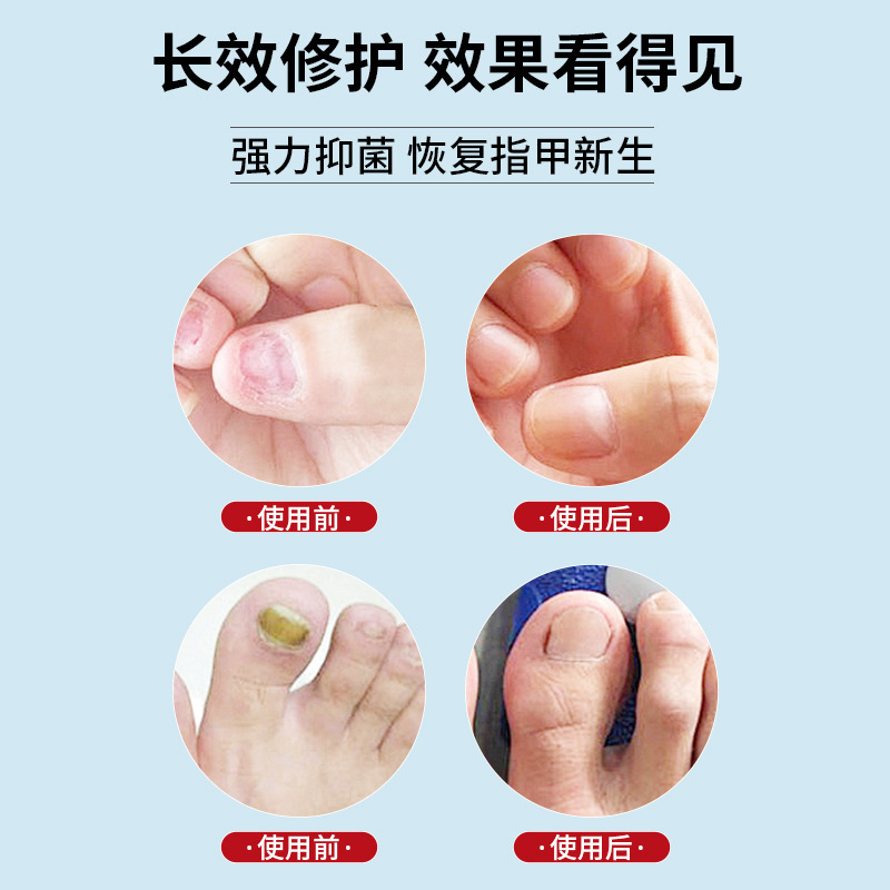 ドイツ爪真菌ペン爪真菌抗菌ジェル爪ケアオールインワンケアソリューション修復感染症腐敗抗菌液体|undefined
