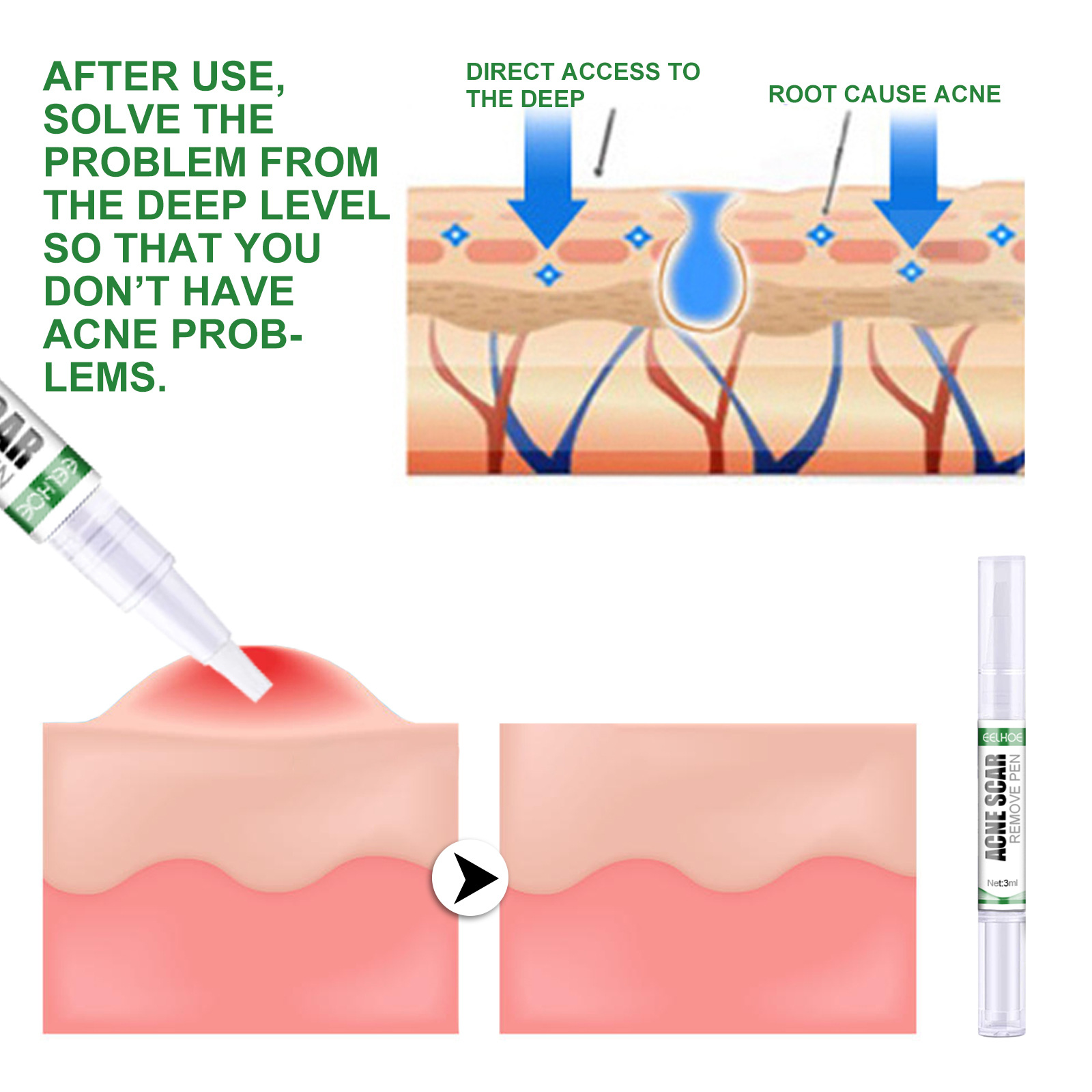 „EELHOE Ac Cleansing Pen“ valomasis pieštukas giliai valo odą, šviesina Ac randus ir atkuria užčiauptos burnos ertmės žaizdas._voghion.com