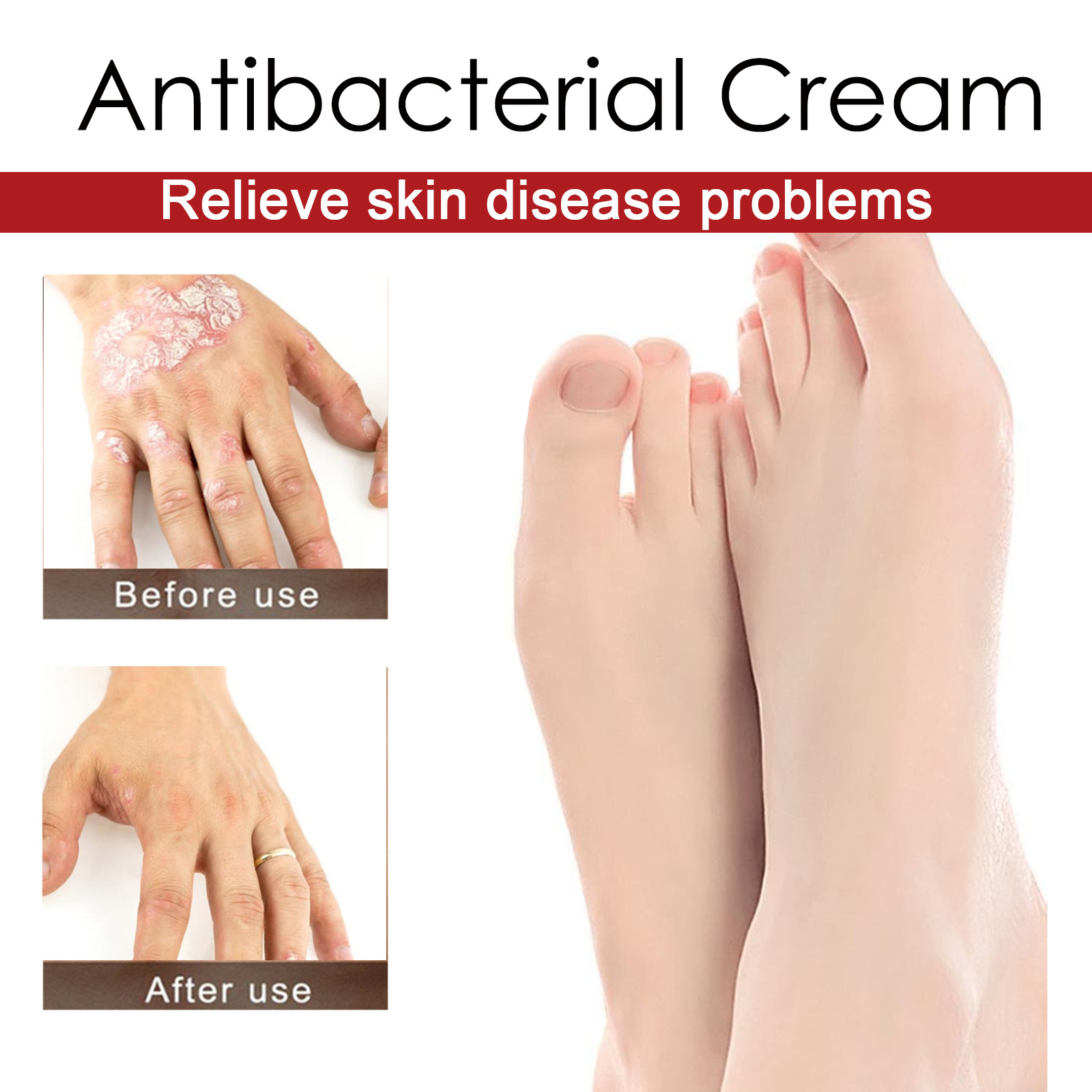 South Moon Psoriasis Care Cream Zarudnutí pokožky těla, svědění, krém proti svědění a lupénce na rukou a nohou_voghion.com