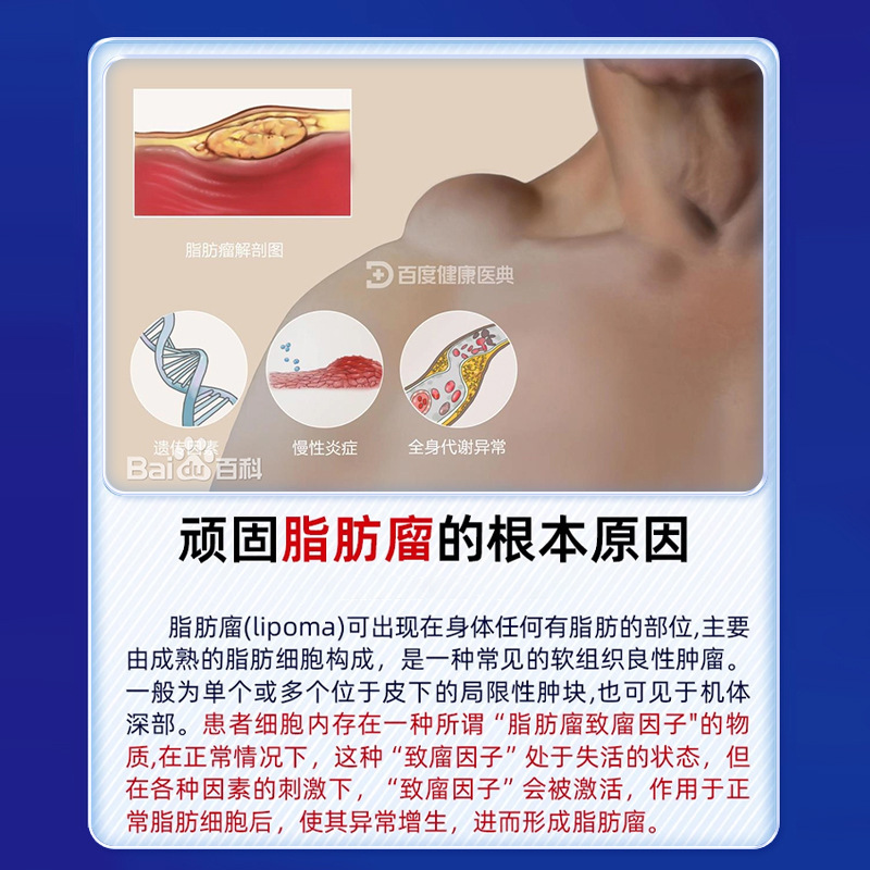 北京同仁堂脂肪康皮下消留去除膏针刀皮下除蓖麻子专用肿硬块去除|undefined