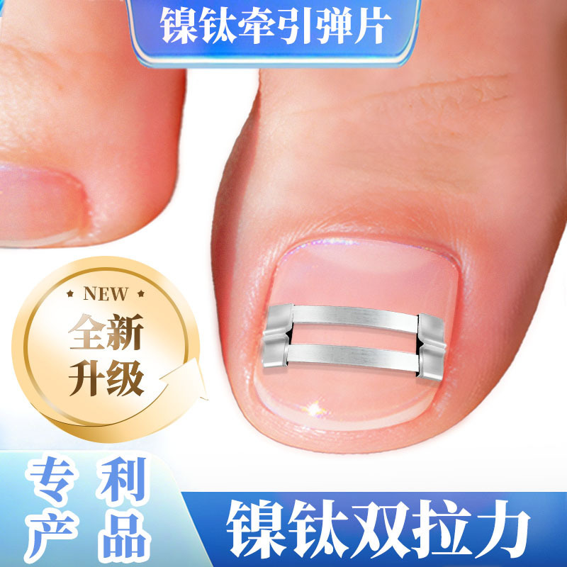 Nail Correction Tool with Memory Alloy Nickel-Titanium Wire for Nail Alignment and Correction Nail Correction Tool with Memory Alloy Nickel-Titanium Wire for Nail Alignment and Correction