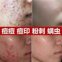 Herbal Acne Cream for Acne Scars, Blackheads, Whiteheads, and Pimples. Beauty Salon Exclusive 