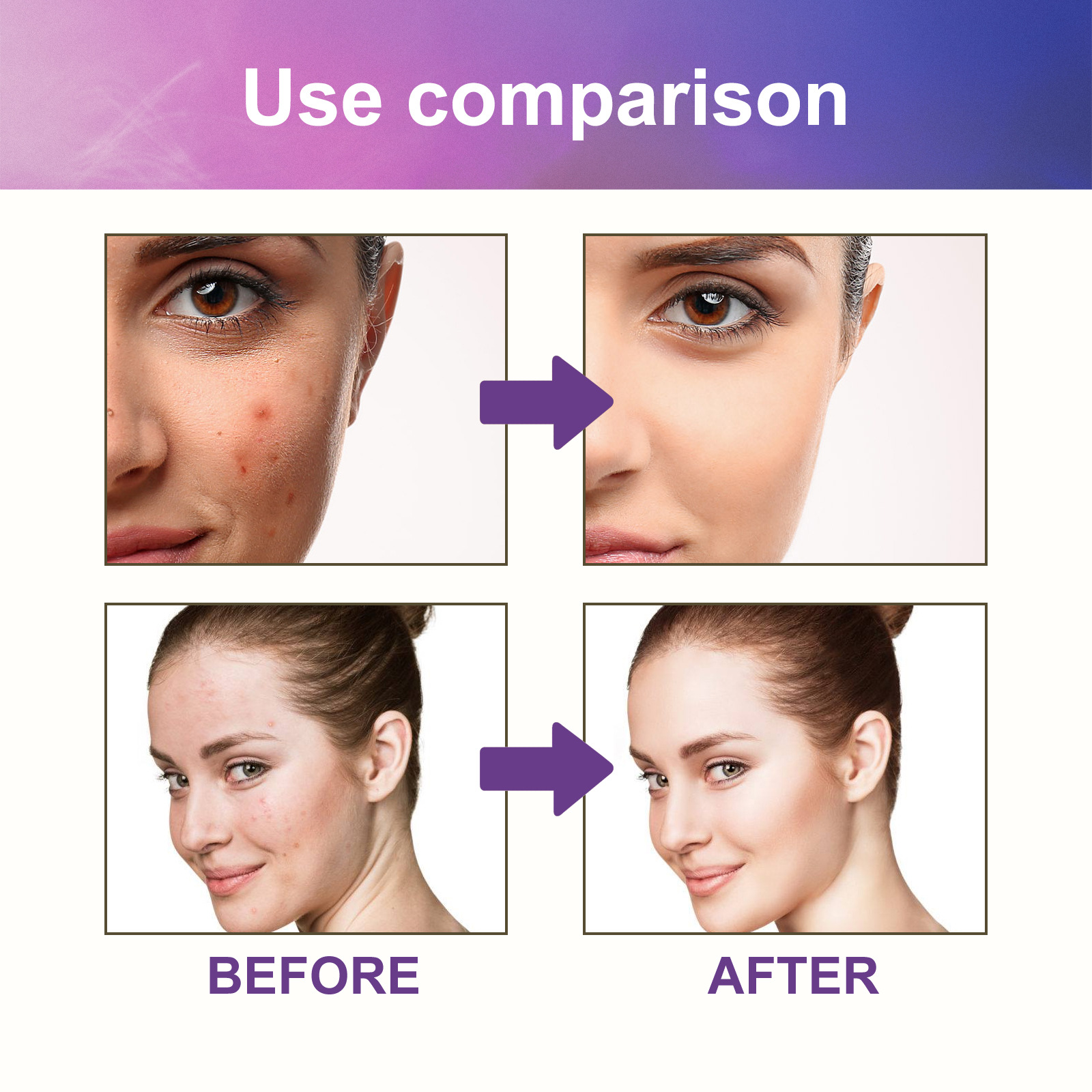 Patch hydrogel acné jaysuing pour atténuer les taches et boutons_voghion.com