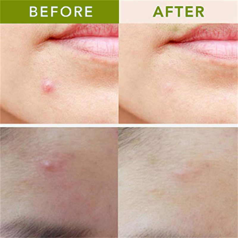 Title 5, Hyaluronsäure-Mikronadel-Akne-Patch