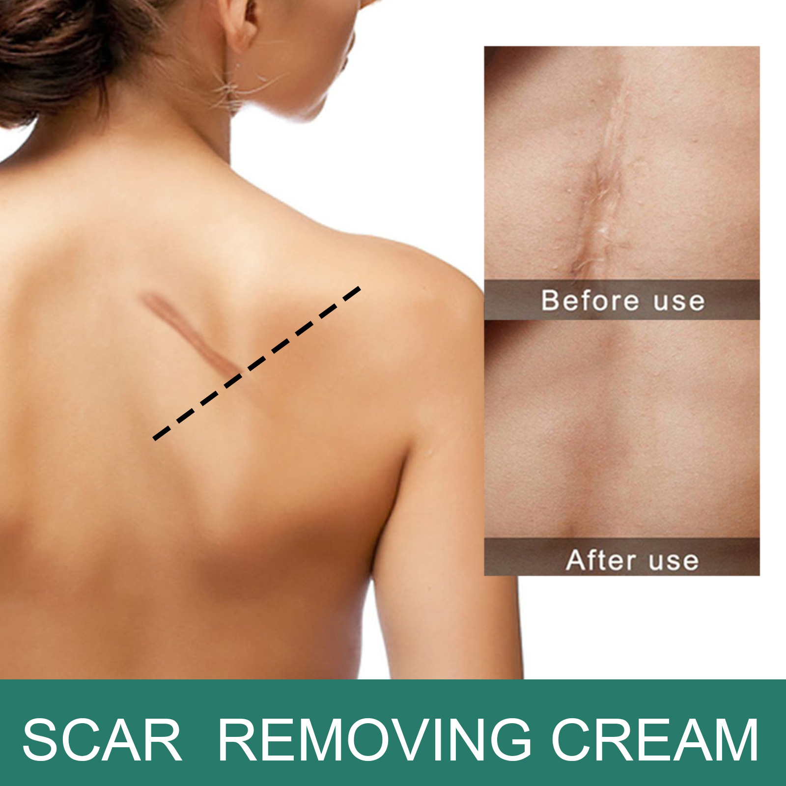 La crema reparadora y aclaradora de cicatrices EELHOE elimina cicatrices de quemaduras, cicatrices antiguas, cicatrices posoperatorias, crema reparadora y suavizante de la piel (paquete de 2)_voghion.com